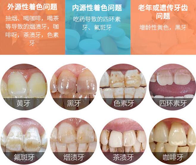 巢湖市第二人民医院口腔科牙齿美白科普