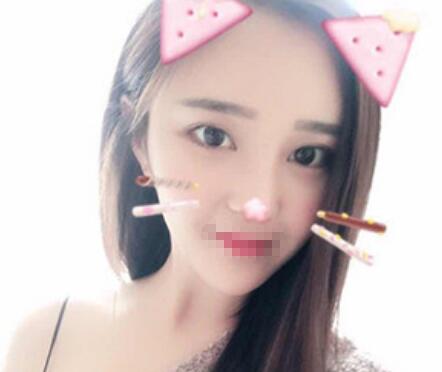 上海古北悦丽医疗美容医院隆鼻案例分享