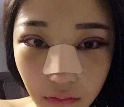 上海古北悦丽医疗美容医院隆鼻案例分享