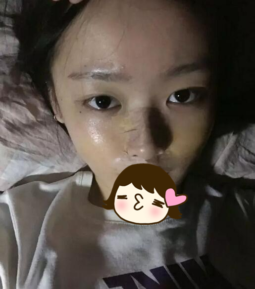 广州奢媛整形医院朱正道隆鼻案例分享