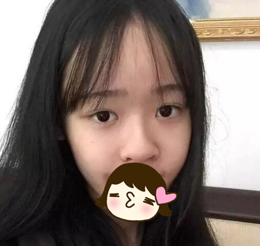 广州奢媛整形医院朱正道隆鼻案例分享