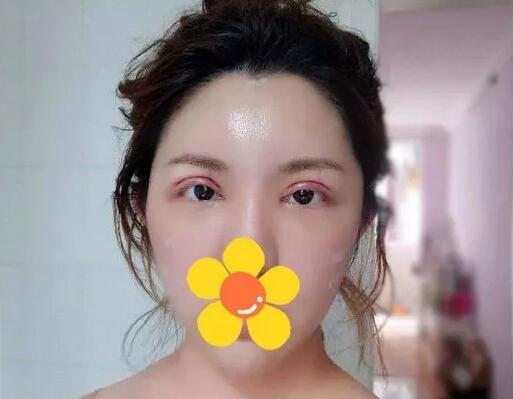 上海珂莱娅整形医院双眼皮案例分享