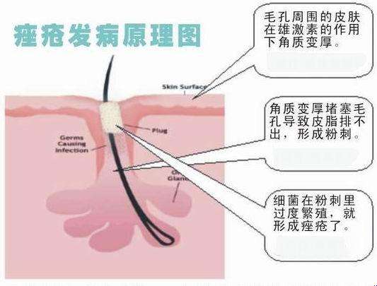 医美方式祛除痘疤