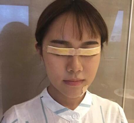 中山大学附属第二医院整形修复外科双眼皮案例