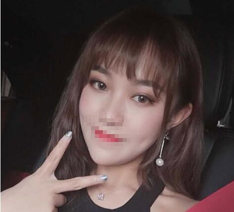 中山大学附属第二医院整形修复外科双眼皮案例