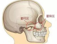 颧骨整形费用是多少？价格的高低受哪些因素影响呢