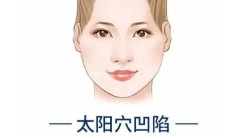 太阳穴凹陷h11.jpg