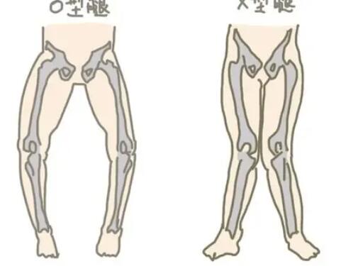 O型腿03.jpg