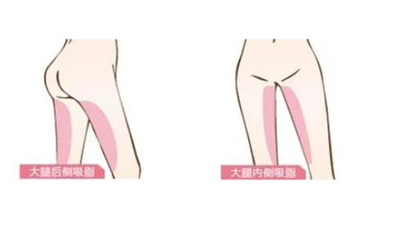 记录我在北京东方和谐整形医院做吸脂过程，还挺痛的！