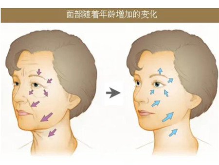 激光去除颈部皱纹有效吗?有哪些优势