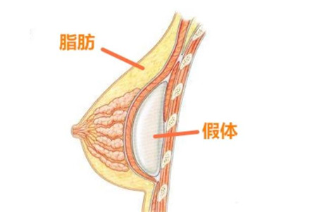 假体隆胸的材料有哪些?