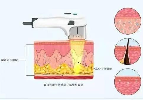 有哪些部位适合做超声刀