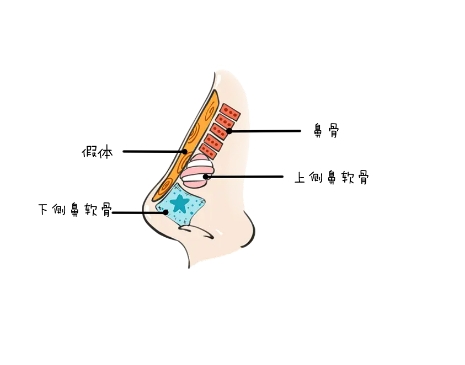 可用于隆鼻的材料有哪些?