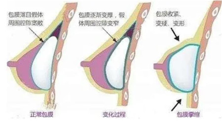 假体隆胸后需要注意什么