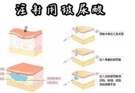 玻尿酸填充卧蚕消肿需要多长时间