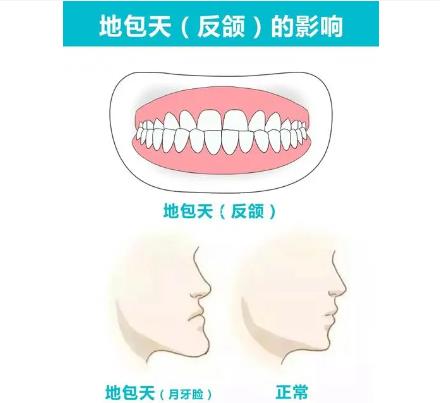 地包天术后需要注意什么?