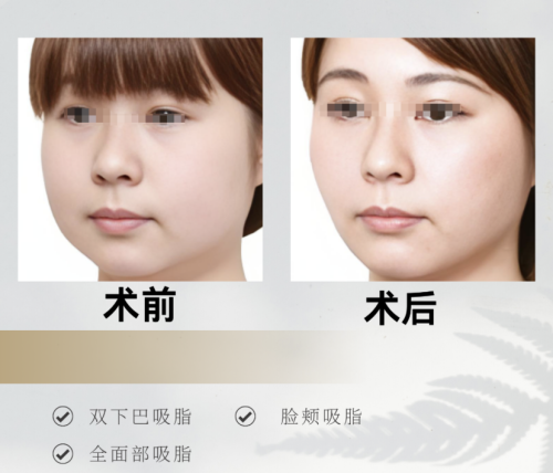 重庆南川区人民医院吸脂多少钱？抽的脂肪越多，收费越高