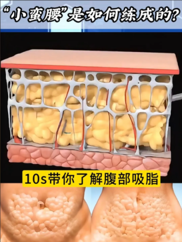 腹部去脂有效的方法： “燃脂+塑形”，2025告别 “游泳圈”不反弹