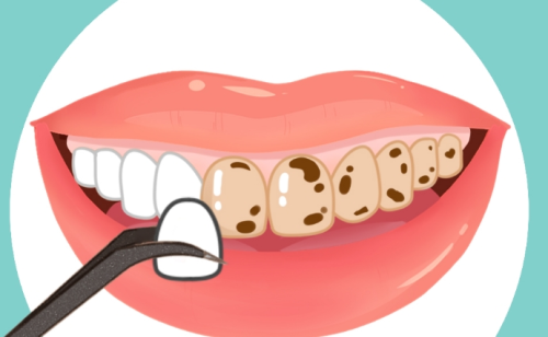 潍坊阳光牙齿贴面怎么样？项目价格到最终效果的综合评价汇总
