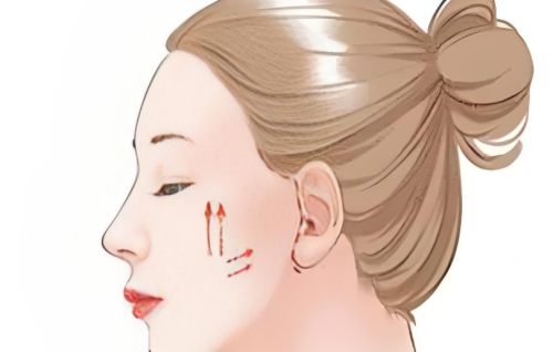 大切口拉皮手术可以维持多久？效果持续时间和影响因素全面分析