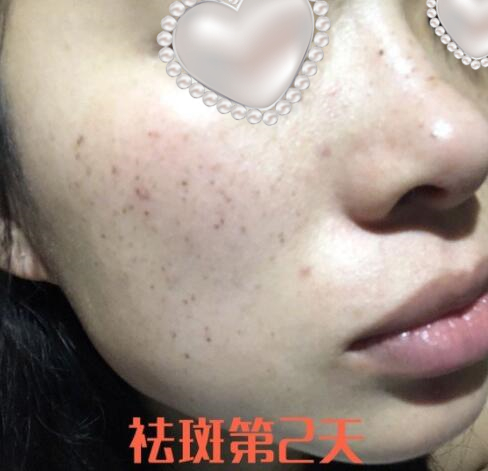 蚌埠祛斑体验日记