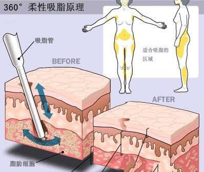 腰腹部吸脂减肥手术科普