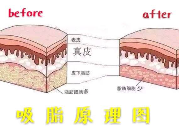 没多少痛感瘦腿吸脂术有吗