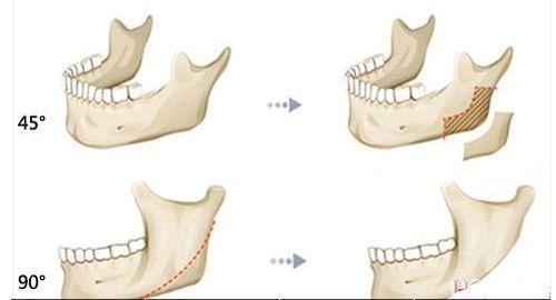 下颌角手术有什么特点?