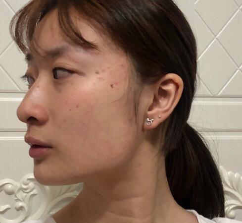 上海九院柴岗磨骨手术案例分享