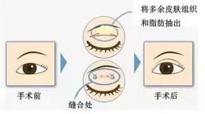 眼皮抽脂术没问题吗