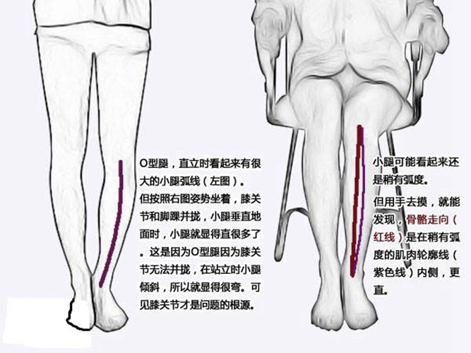 O型腿矫正