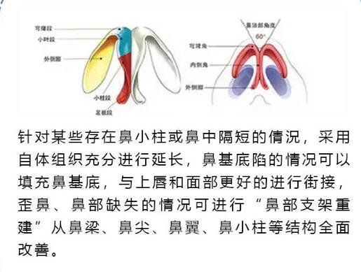 巫文云医生科普软骨隆鼻手术