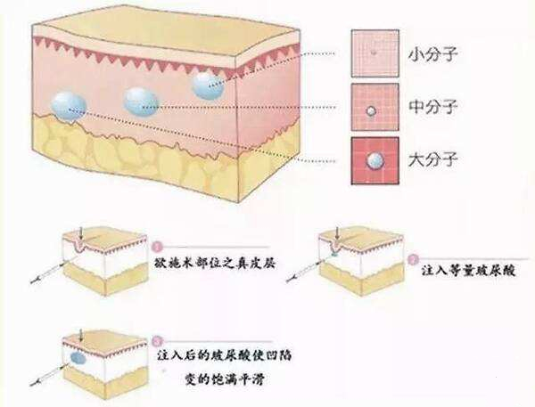 透明质酸注射除皱