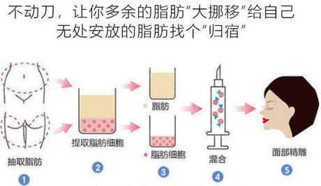 泪沟填充什么材料好