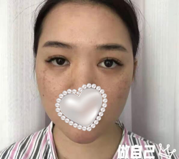 东莞壹加壹整形美容隆鼻案例