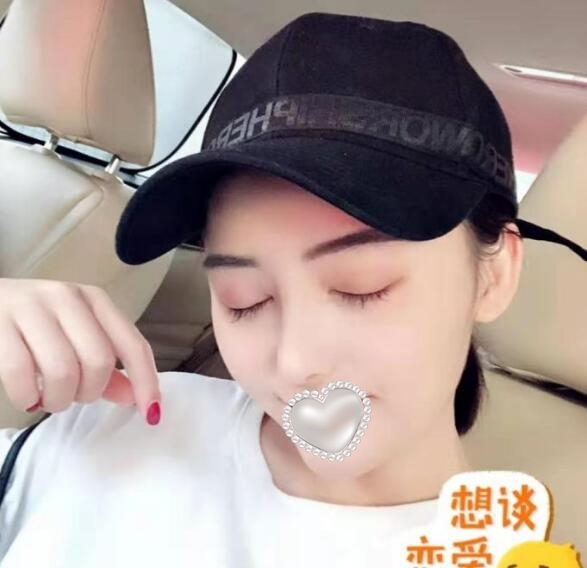 东莞壹加壹整形美容隆鼻案例