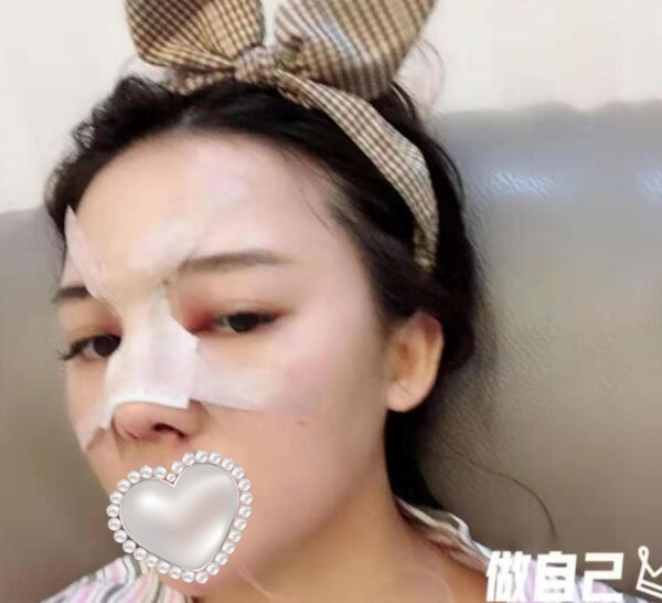 东莞壹加壹整形美容隆鼻案例