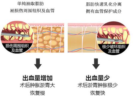 四、八大处美容整形科普腰腹吸脂手术