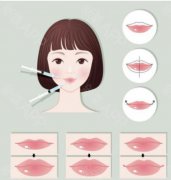 玻尿酸丰唇多少钱一针？果自然吗？来看下对比图吧！