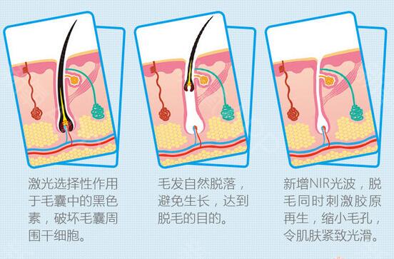 使用激光方式去除络腮胡