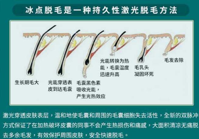 使用激光方式去除络腮胡