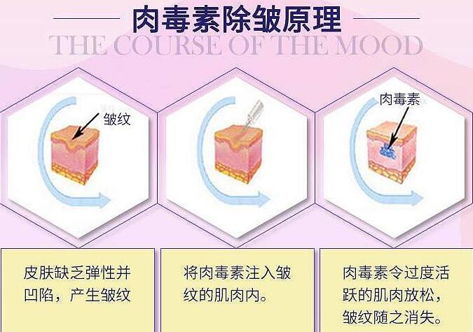 昆明大华医疗美容金宝玉医生科普注射除皱