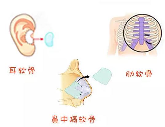 中山一院整形科科普什么是自体软骨隆鼻