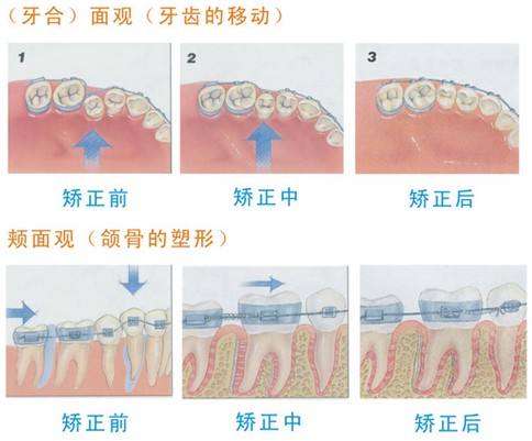 四川华西医院口腔科专家科普牙齿矫正