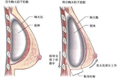 北京协和医院科普隆胸手术