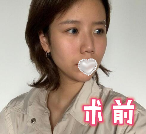 鼻尖整形对比图美照分享!精致女孩细节控必看美鼻日记!