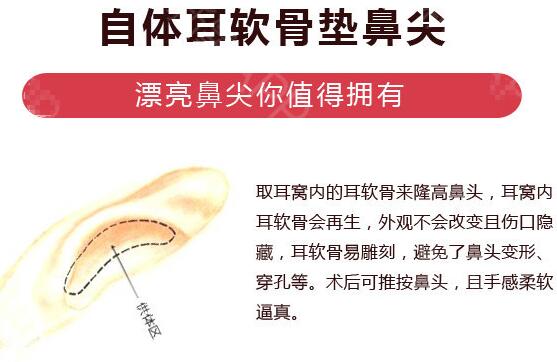 低鼻尖整形美容常见问题