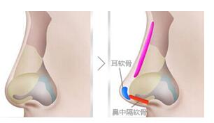 成都华西医院美容科科普隆鼻整形手术