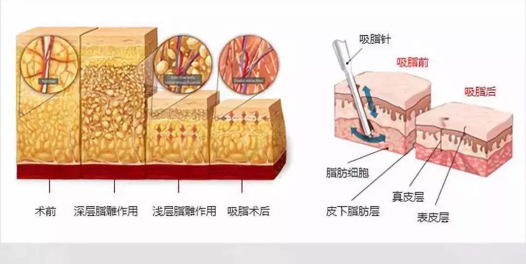 萍乡丽芙整形医院科普吸脂减肥