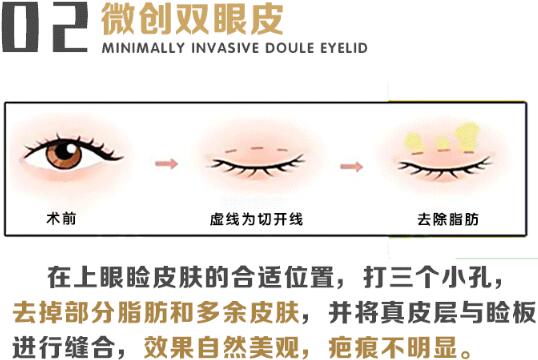 布仁医生科普双眼皮手术